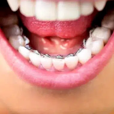 Bonded Retainers | Space City Orthodontics - Houston and Clear Lake, Texas